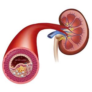 Renal Hypertension: What It Is and How to Manage It